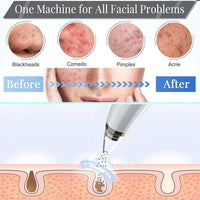 Vacuum Blackhead Remover Cleaner